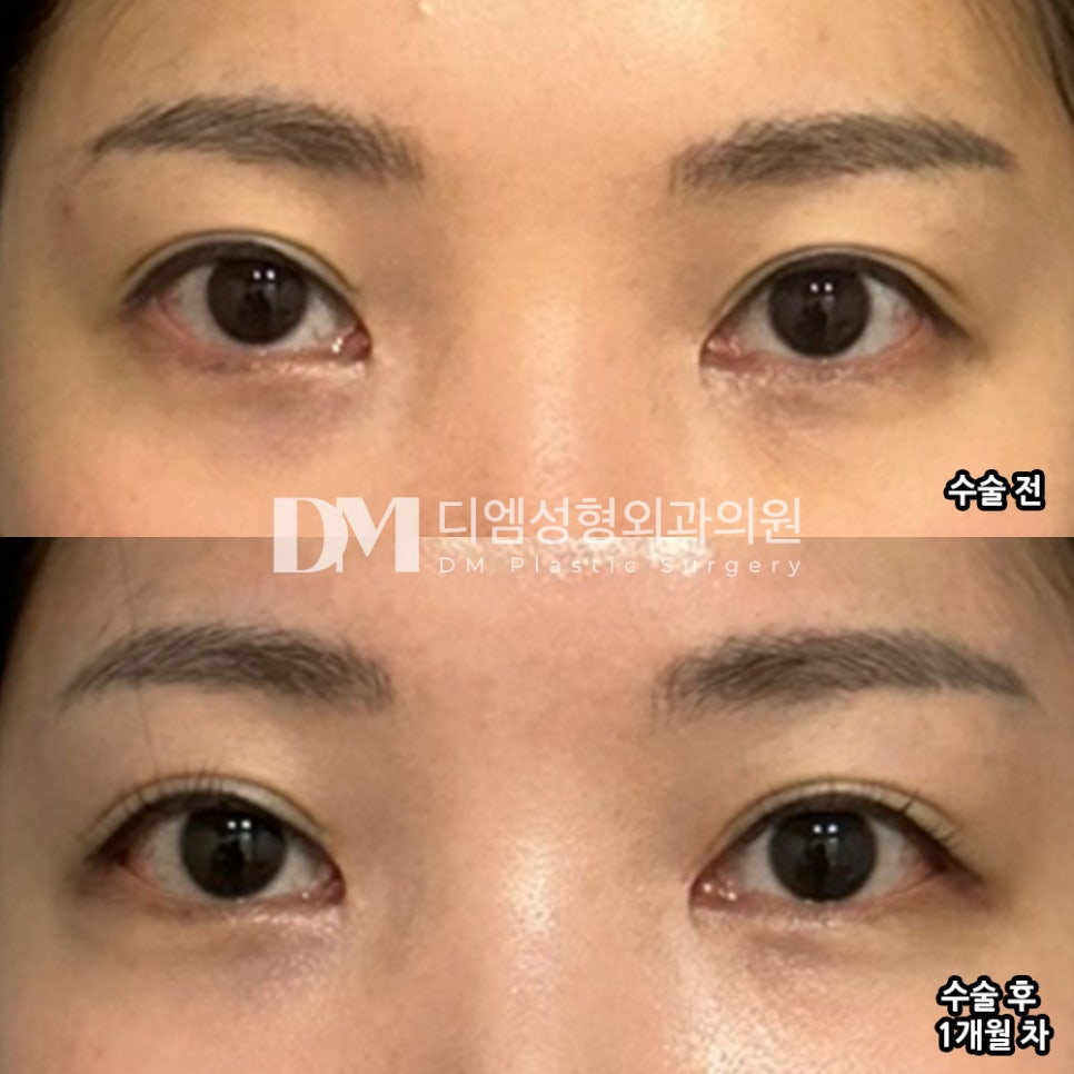 Canthoplasty Review: “Overall, I’m satisfied, and I was glad they also checked the areas I was worried about!” image 2
