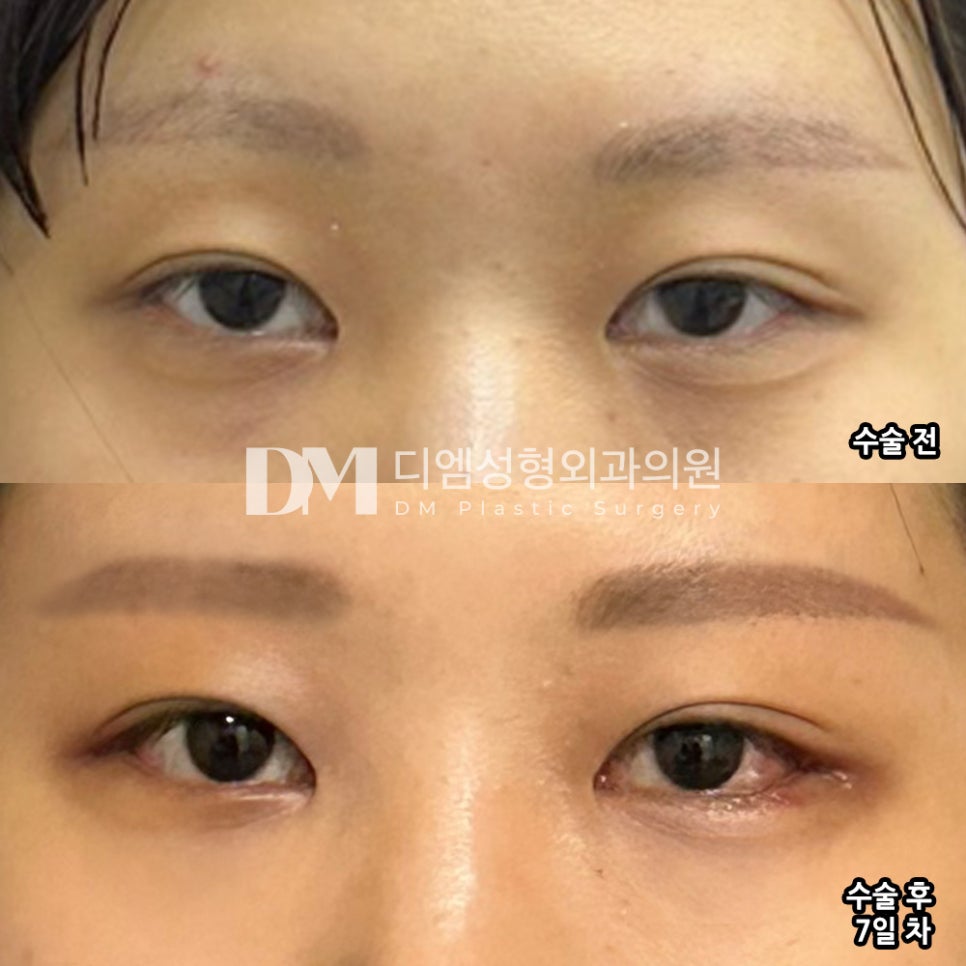 빵트임 후기."멍도 거의 안들고 회복도 빨라서 좋아요!" 관련 이미지 2