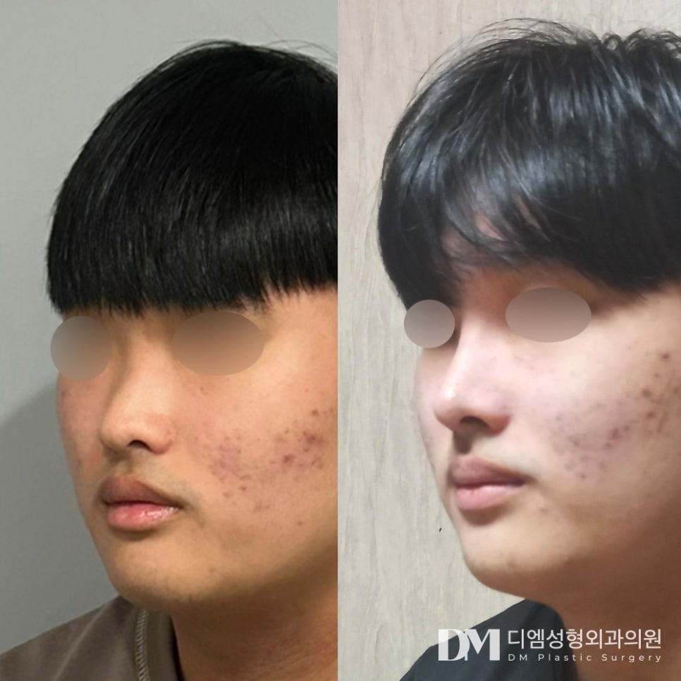 코끝성형, 세련된 이미지를 주고싶다면? 관련 이미지 8