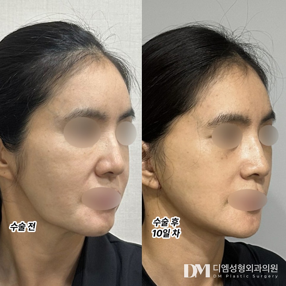 안면거상 후기."얼굴 라인이 살아나고 눈가 주름이 안 보여서 너무 좋았습니다." 관련 이미지 2