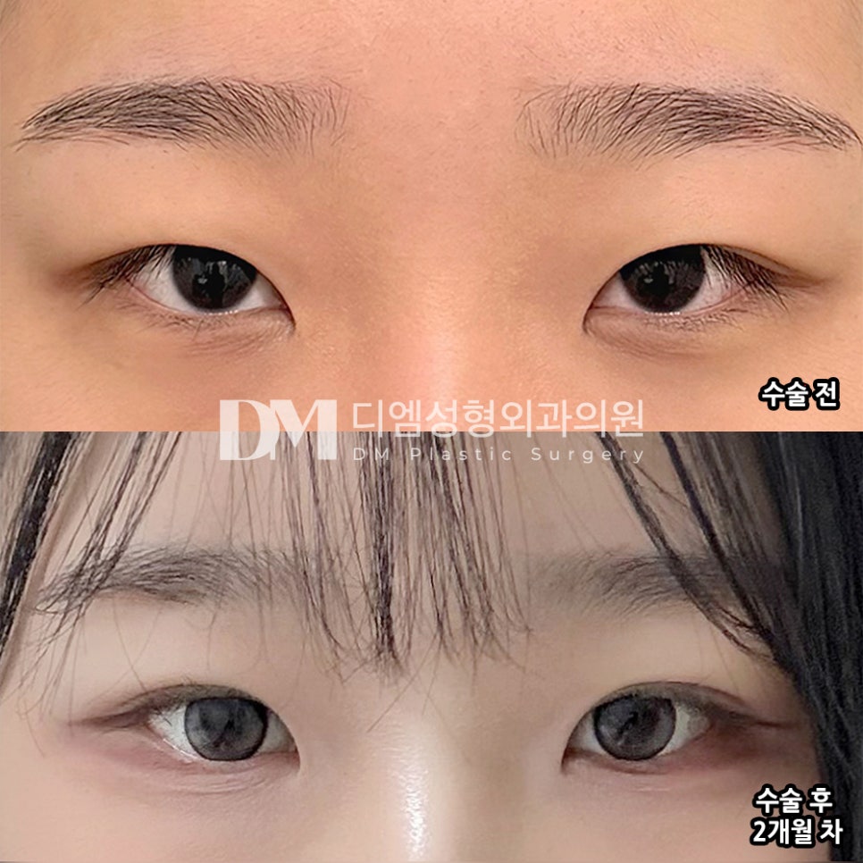 디엠 눈매교정/눈성형 후기, “정말 너무 만족하고 있어요!” 관련 이미지 2