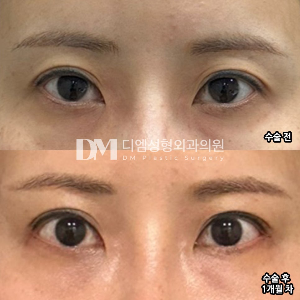 Bangtteim Review. “They say my expression looks more relaxed!” image 2