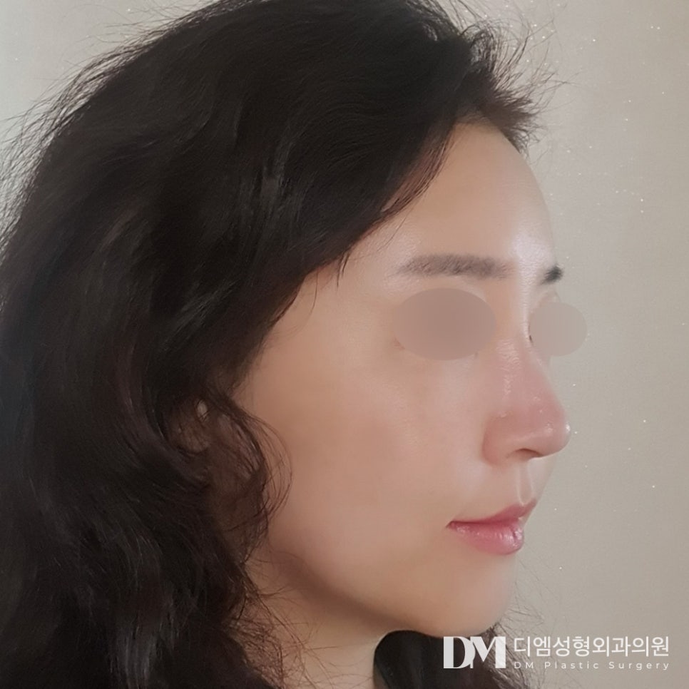 냉동지방이 아닌 생생 지방으로 ! 디엠 얼굴지방이식 관련 이미지 7