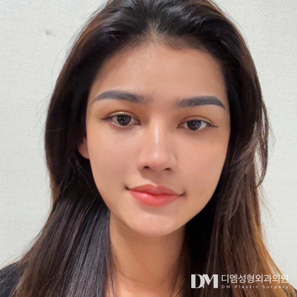 눈 밑 개선으로 환한 동안 인상 되기 관련 이미지 10