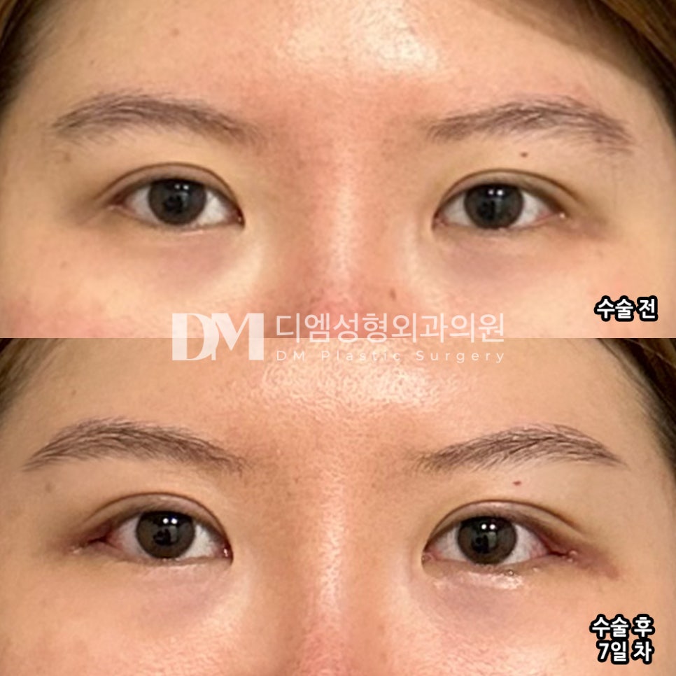 Blepharoplasty Opening Surgery Review: "I’m satisfied with everything from the consultation to the results!" image 2