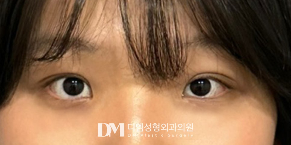 겹주름이 져 피곤한 인상으로 보인다면? 관련 이미지 11