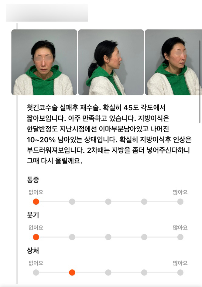 코성형,얼굴지방이식 후기"아주 만족하고 있습니다!" 관련 이미지 1