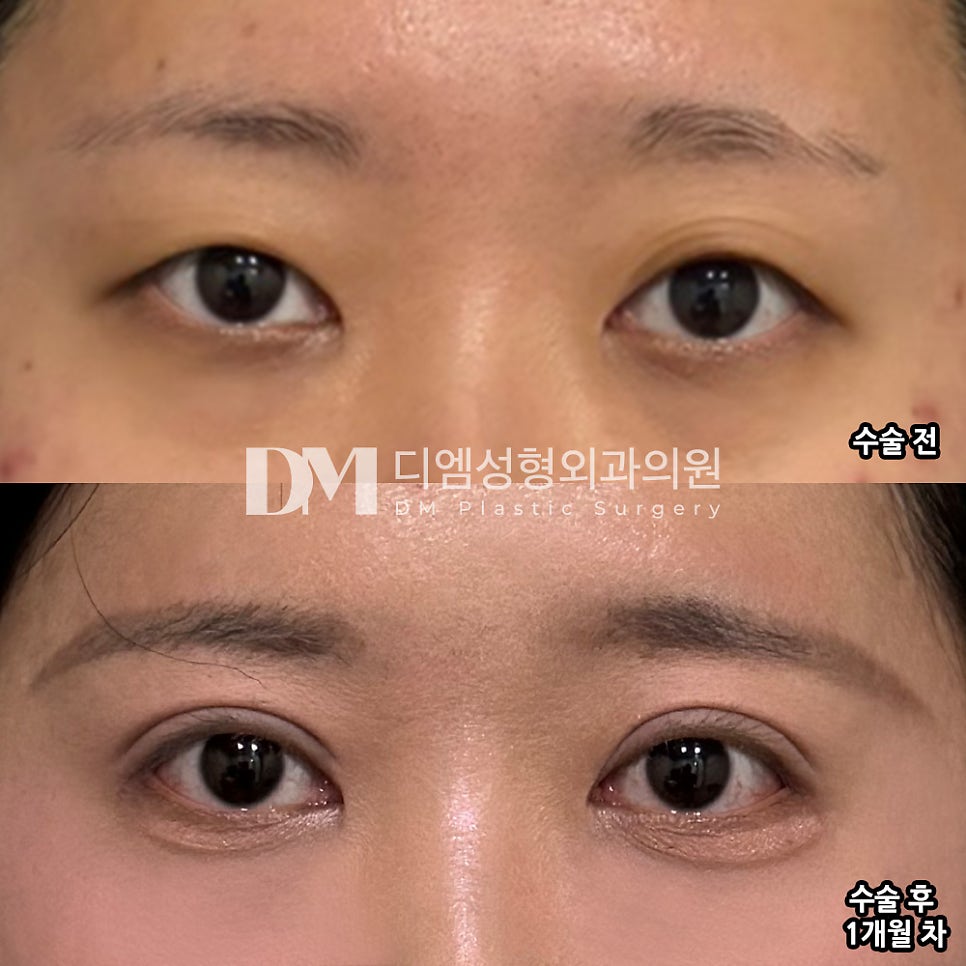 눈성형 후기."원장님과 1대 1로 상담할 수 있어서 신뢰가 가더라고요!" 관련 이미지 2