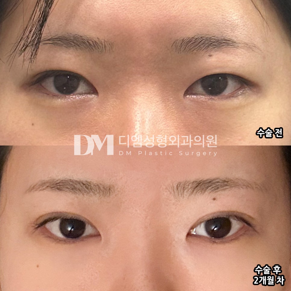 눈재수술 후기."자연스럽고 니즈에 맞춰 잘해주셔서 대만족!" 관련 이미지 2