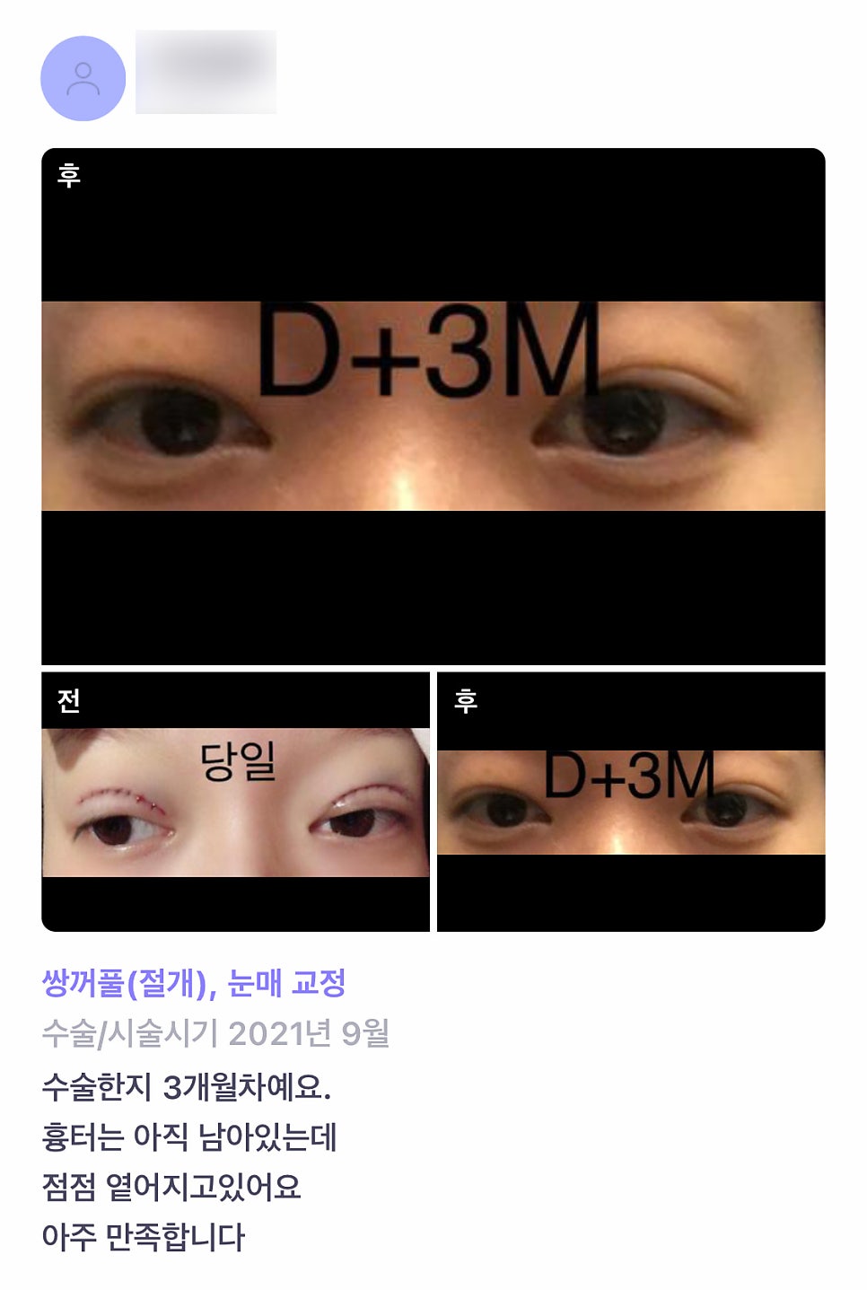 Review of Revision Eye Surgery. “The scar is gradually fading, and I’m satisfied!” image 1