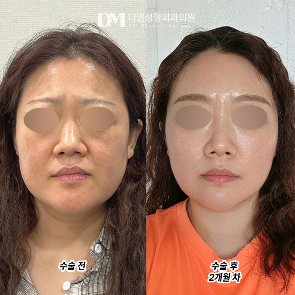 디엠 안면거상 전후사진, 무너진 얼굴 라인이 고민이라면? 관련 이미지 2