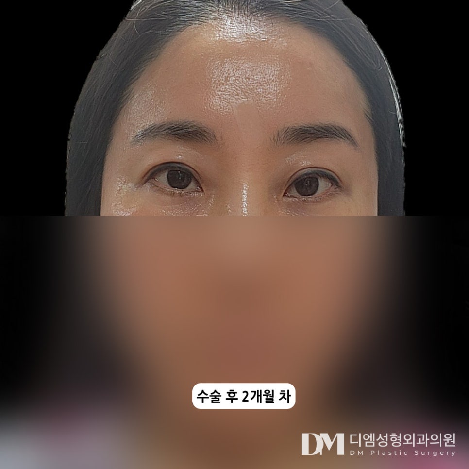 Forehead Lift for a Natural, Youthful Appearance! image 8