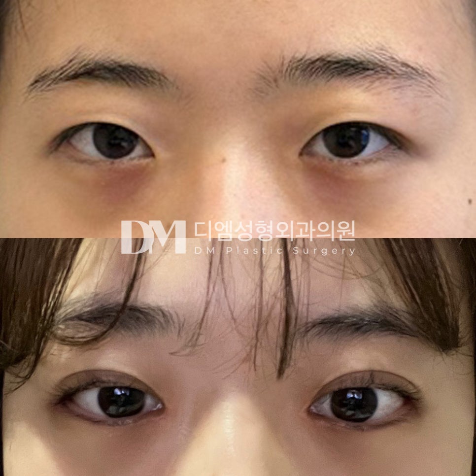 눈성형 후기."무엇보다도 자연스러워서 제일 만족스러워요" 관련 이미지 2
