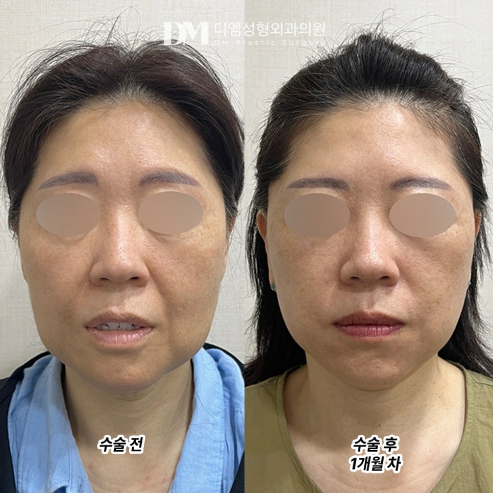 디엠 안면거상 전후사진, 탄력 잃고 늘어진 피부 되살리는 비결은? 관련 이미지 2