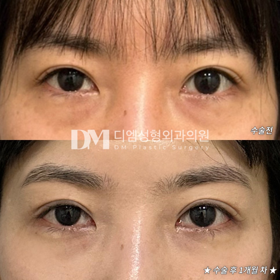 눈재수술 후기."정말 자연스럽게 하고싶은 분께 추천드려요!" 관련 이미지 2