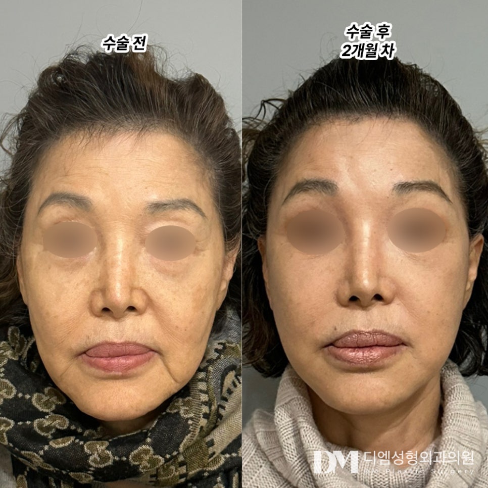 안면거상, 탄력을 잃은 피부가 고민이라면 관련 이미지 6