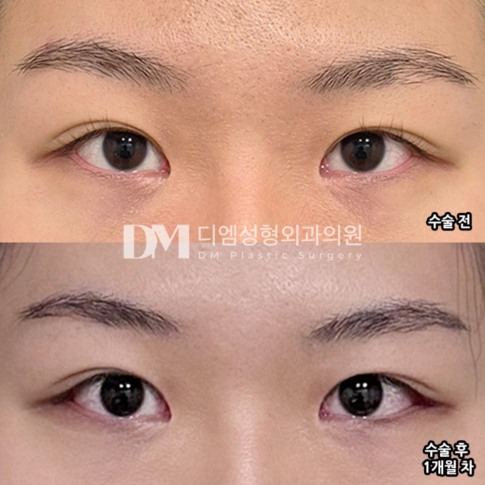 디엠 빵트임 수술후기, &ldquo;뒤밑트임이 제일 효과 만족인 것 같아요!&rdquo; 관련 이미지 2