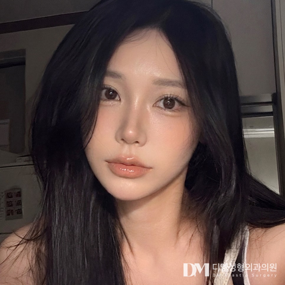 눈성형 후 토안증, 원인과 해결법은 무엇일까? 관련 이미지 1
