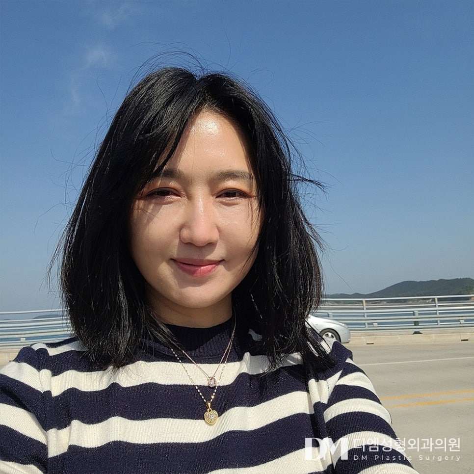 상안검, 처진 눈매 개선을 위한 중년 눈성형 관련 이미지 1