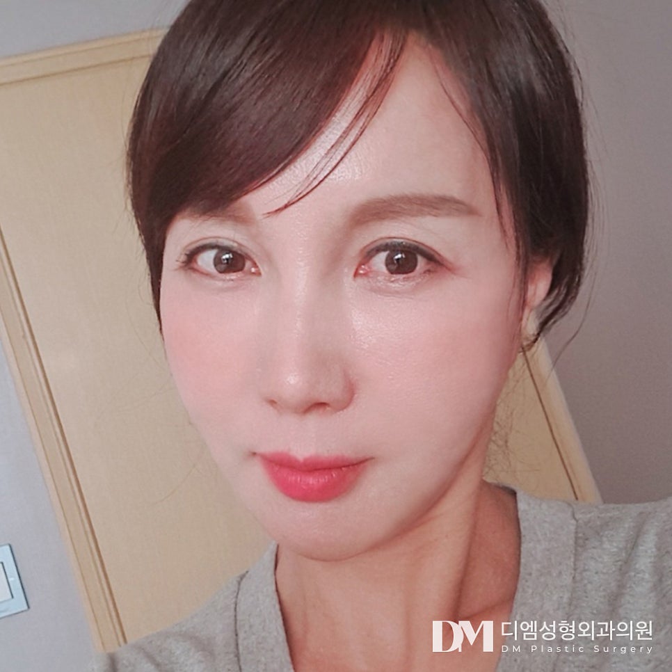 Facelift: Restoring Sagging Skin That Has Lost Its Firmness image 1