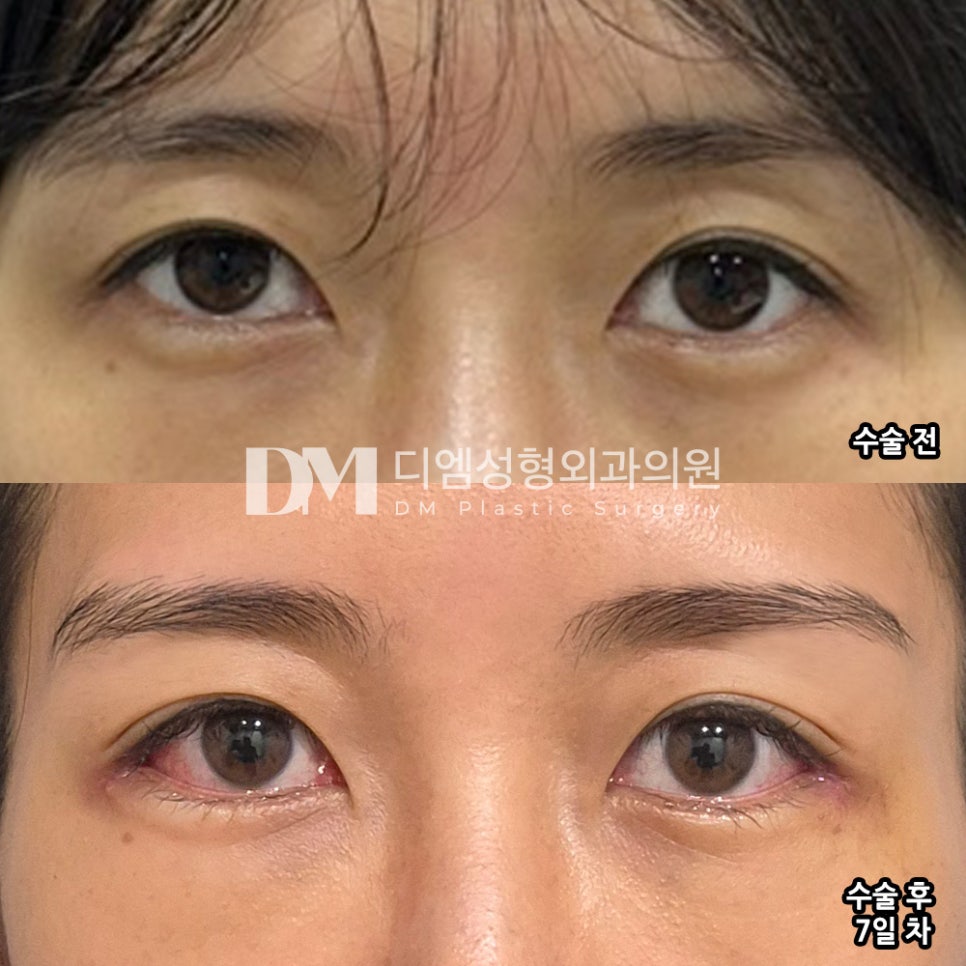 Review of Ppangteum. "My eyes definitely look bigger, and the part at the outer corners that felt cramped seems a bit more open now~" image 2
