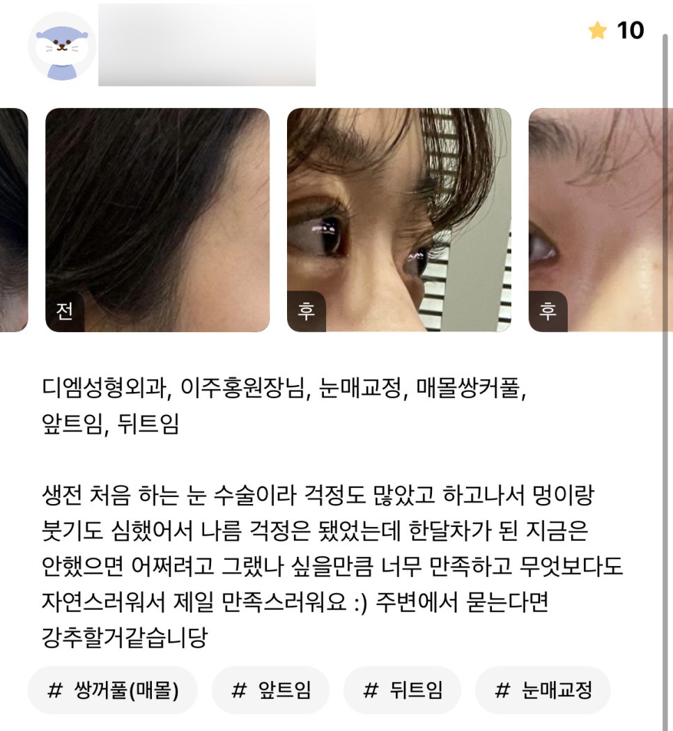 눈성형 후기."무엇보다도 자연스러워서 제일 만족스러워요" 관련 이미지 1