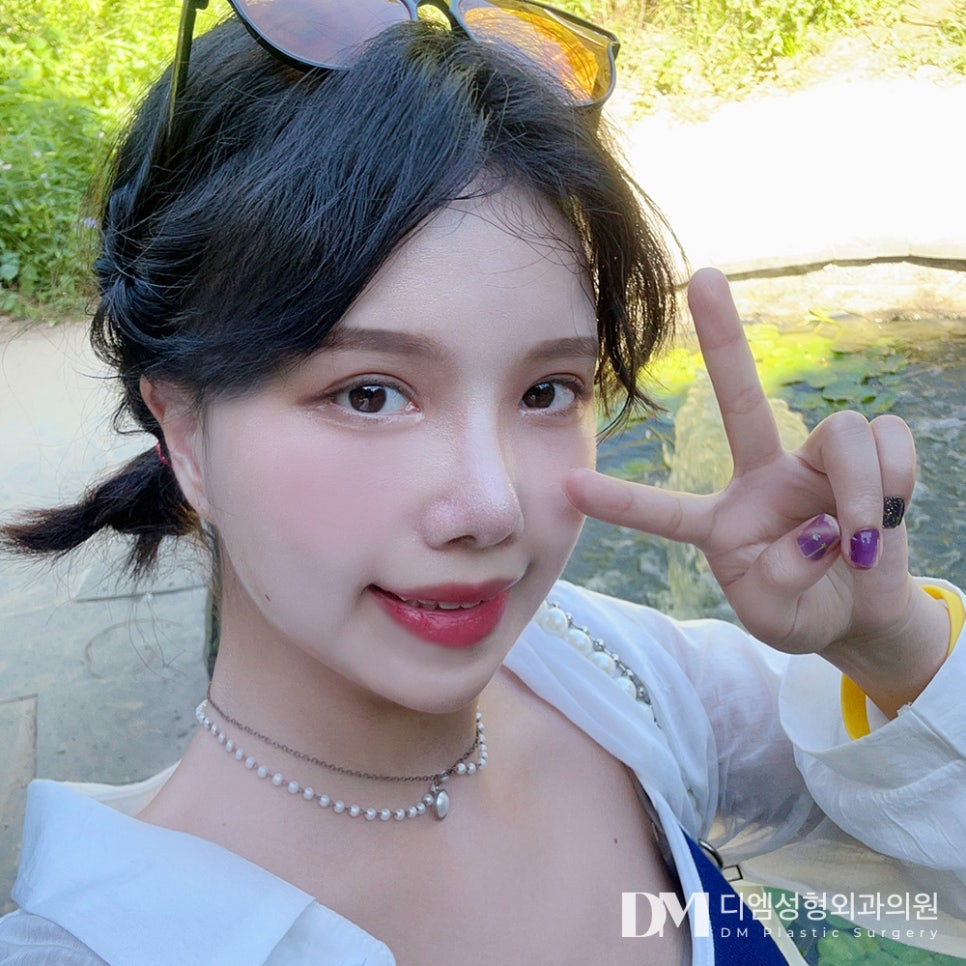 짧은코성형 세련된 옆라인 만들기 관련 이미지 11