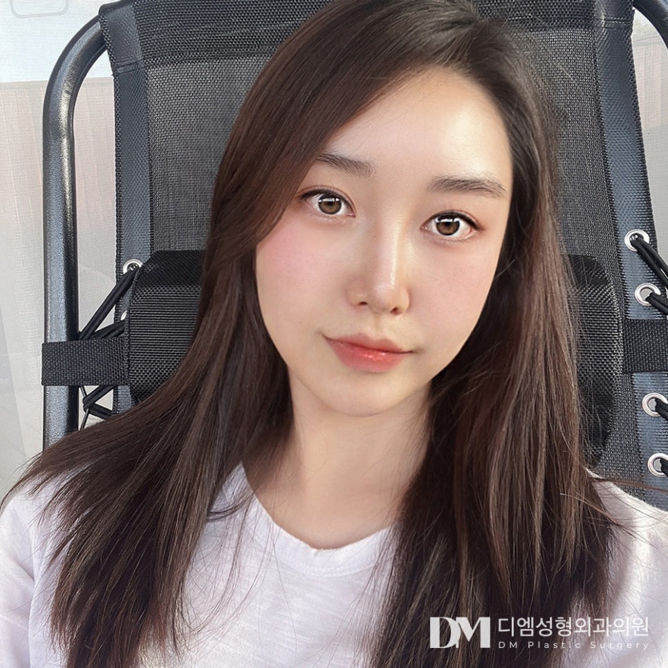 뒤트임과 밑트임 동시에 가능한 트임성형, 빵트임 수술대상은? 관련 이미지 2