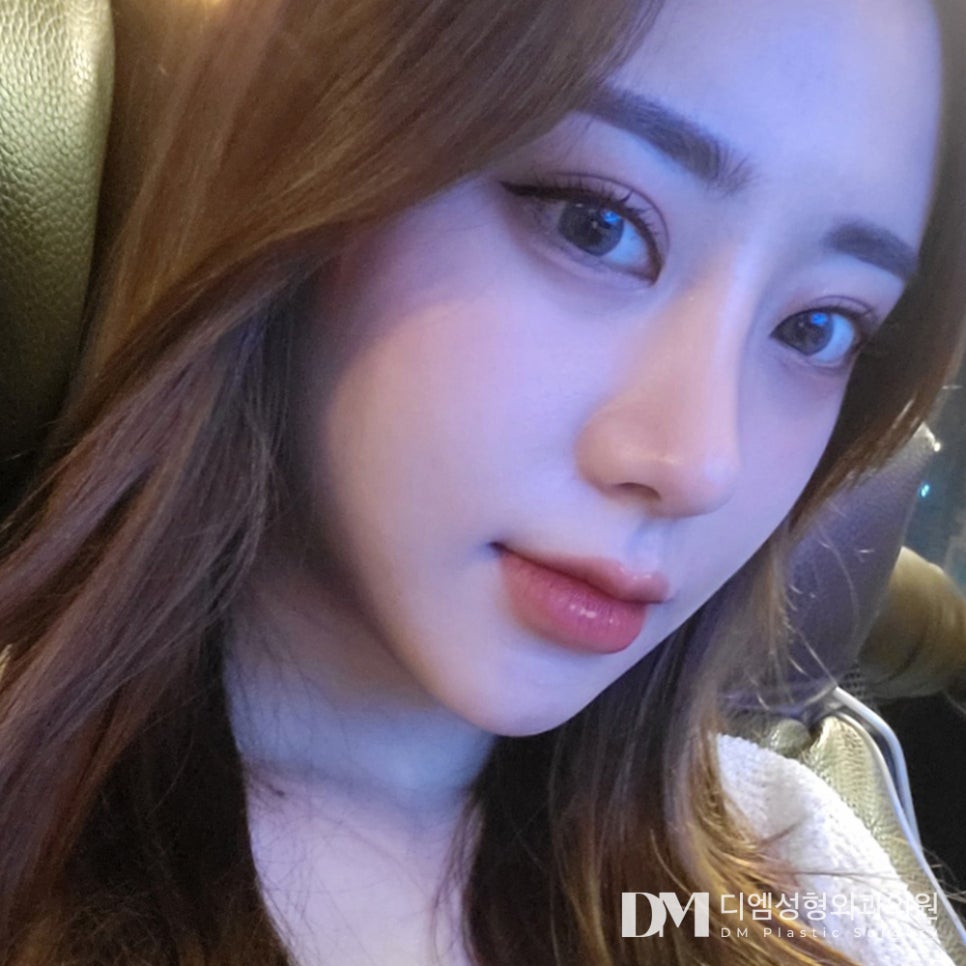 뒤밑트임, 디엠만의 노하우로 자연스럽게 빵! 트인 눈매 관련 이미지 9