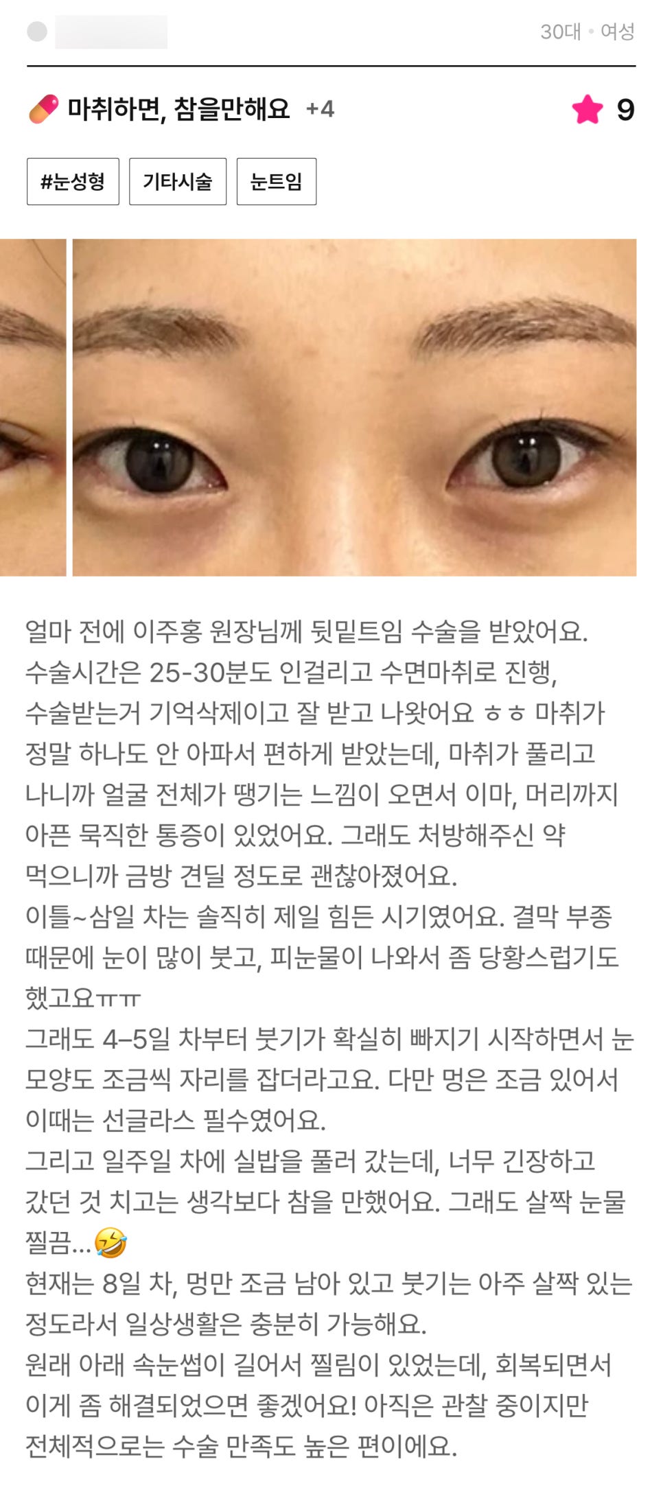 Lower Outer Canthoplasty Review. "Overall, I’m very satisfied!" image 1