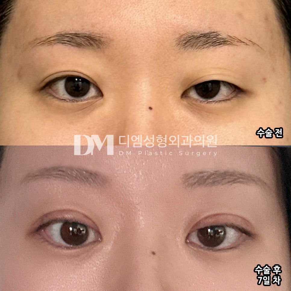 Eyelid Reoperation Review. “If my double eyelid crease loosens again, I’ll have the reoperation done here too!” image 2