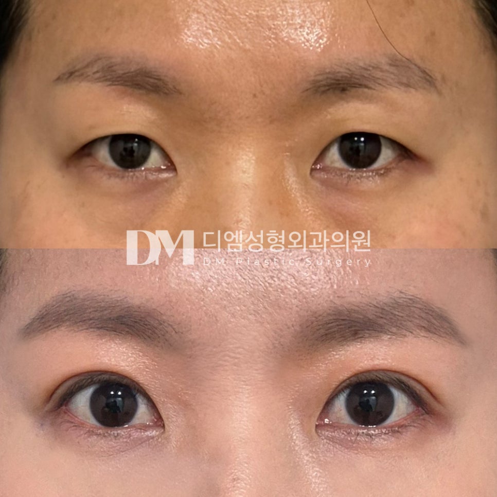 눈성형 후기."또렷한 눈매로 변화하여 인상이 더욱 밝아졌습니다" 관련 이미지 2