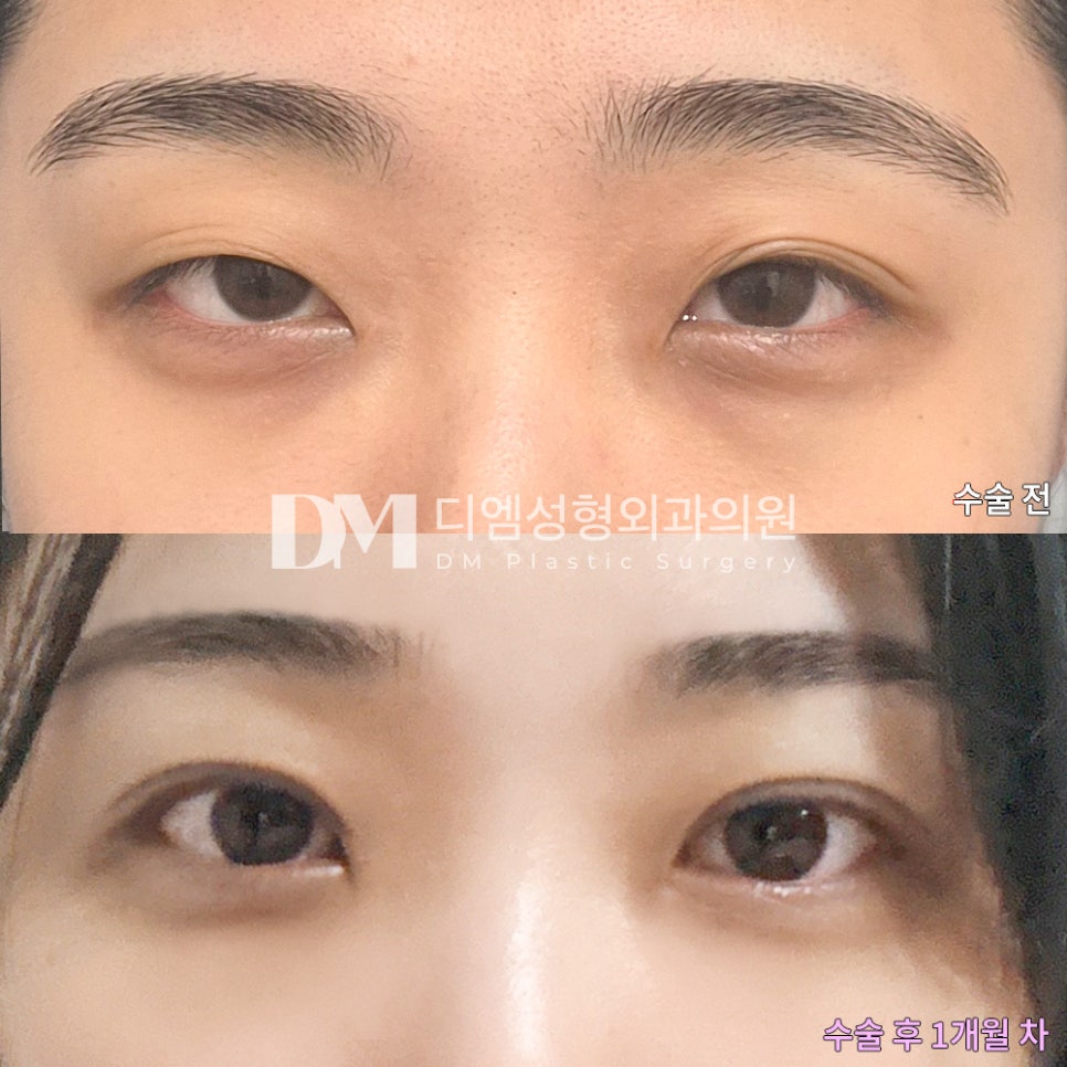 Revision Eyelid Surgery Review. “The line is so beautiful because you performed the surgery so carefully!” image 2