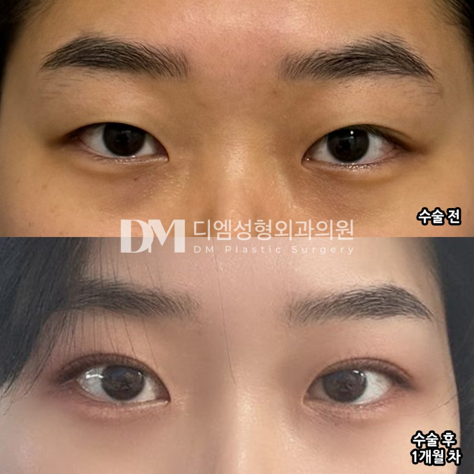 눈성형 후기."통증 없고 딱 제 눈 같아요!" 관련 이미지 2