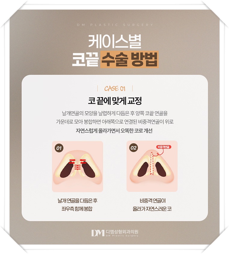The Secret to Creating a High Nose Bridge, Nasal Tip Surgery image 5