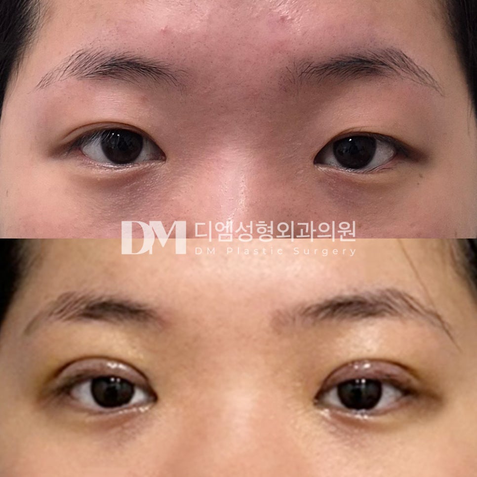 눈재수술 후기."첫 수술보다 라인도 훨씬 더 예쁘고 너무 만족스러워요!" 관련 이미지 2