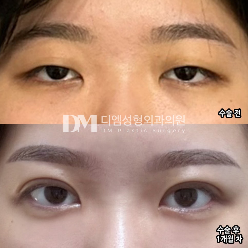 눈성형 후기."시술 후 라인이 자연스럽게 잡혀서 거울 볼 때마다 너무 좋아요 !!" 관련 이미지 2