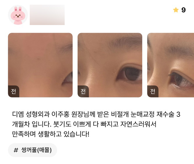 Eye Revision Surgery Review. "It Looks Natural, So I’m Happy with It in My Everyday Life!" image 1