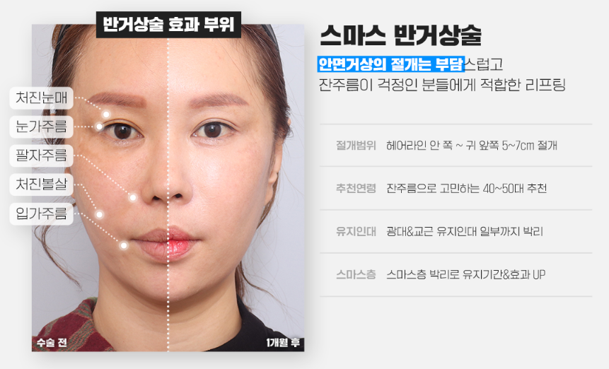 반거상, 흉터걱정은 덜고 리프팅 효과는 올리고! 관련 이미지 3