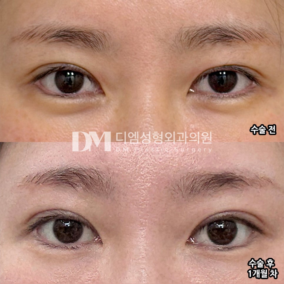 디엠 눈재수술 후기, &ldquo;매일이 만족스럽습니다!&rdquo; 관련 이미지 2