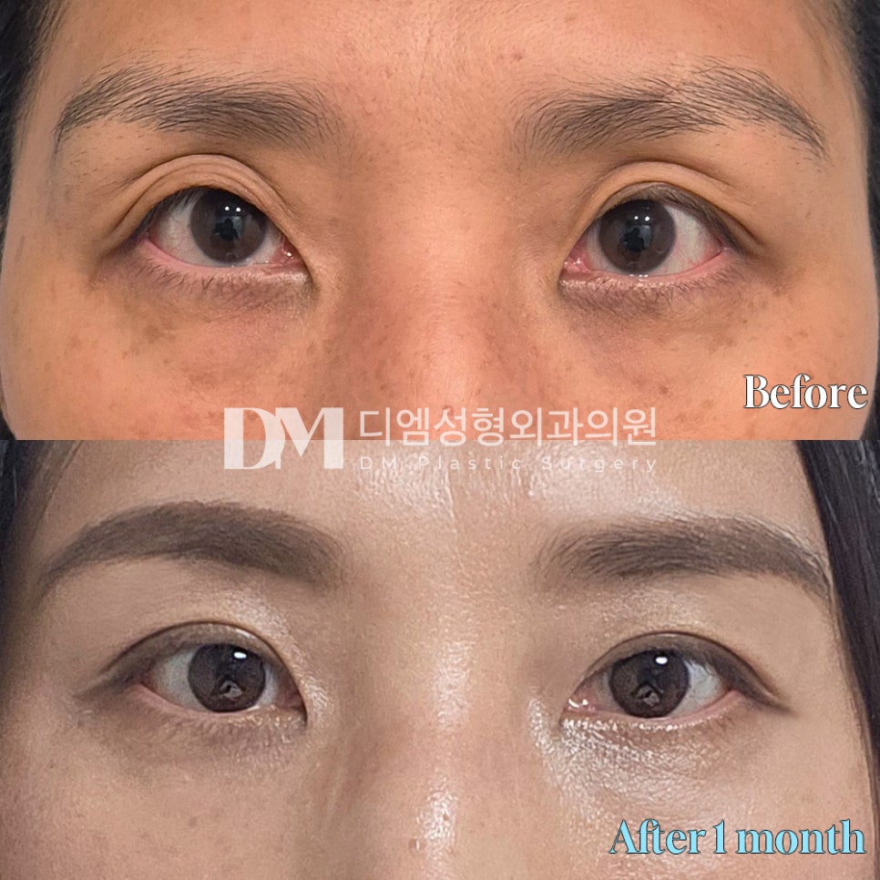 Blepharoplasty Review: "The swelling has all gone down and there are no scars, so I’m satisfied!" image 2