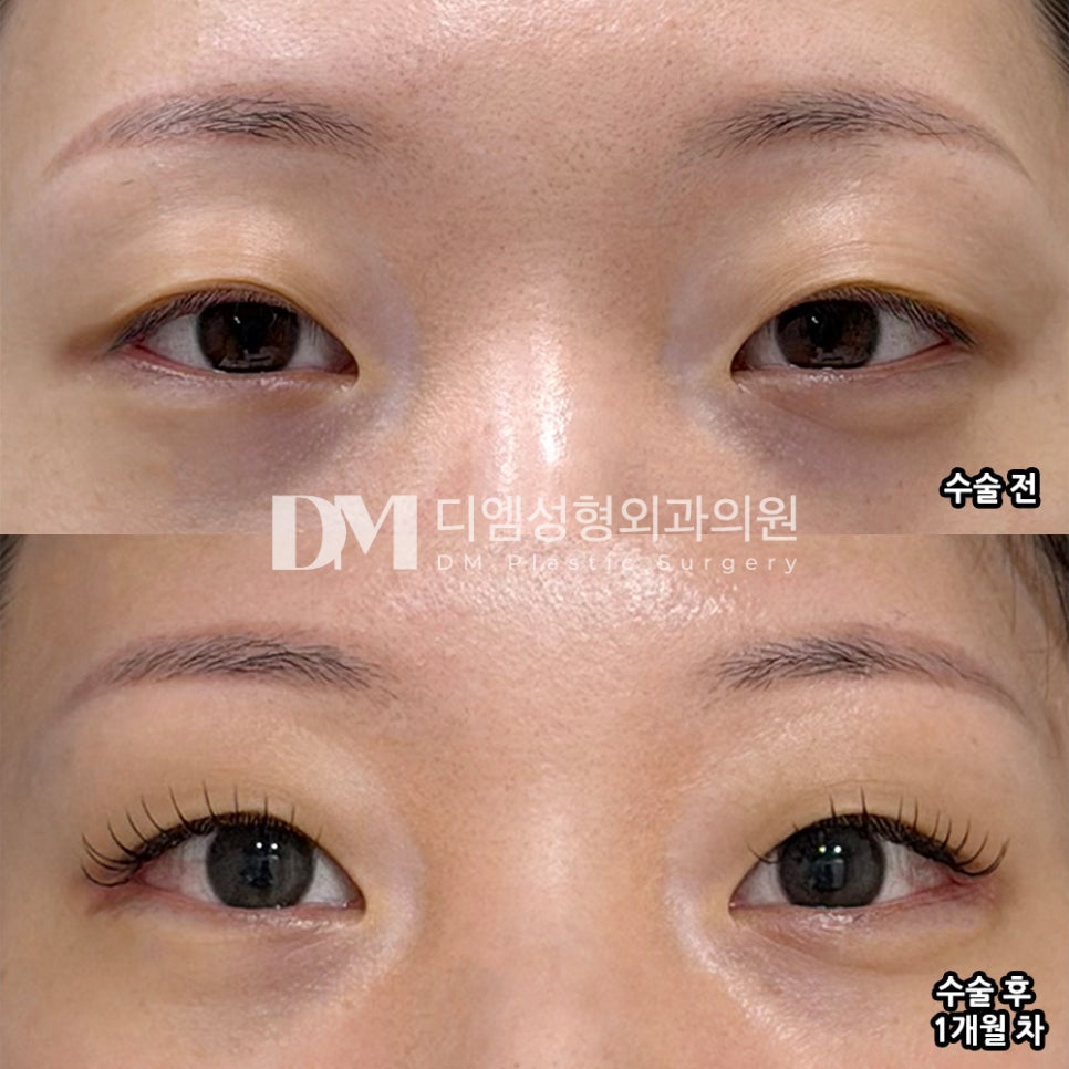 DM Lateral and Lower Canthoplasty Surgery Review, “My eyes definitely look more open and refreshed, and I’m very satisfied!” image 2
