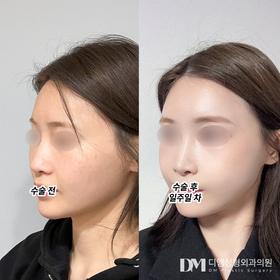 얼굴지방이식, 작고 입체적인 얼굴이 되려면? 관련 이미지 6