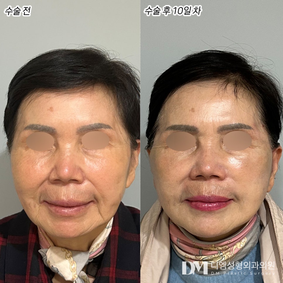 안면거상 후기."맞춤 케어가 좋았고 수술 결과가 만족스러워요!" 관련 이미지 2