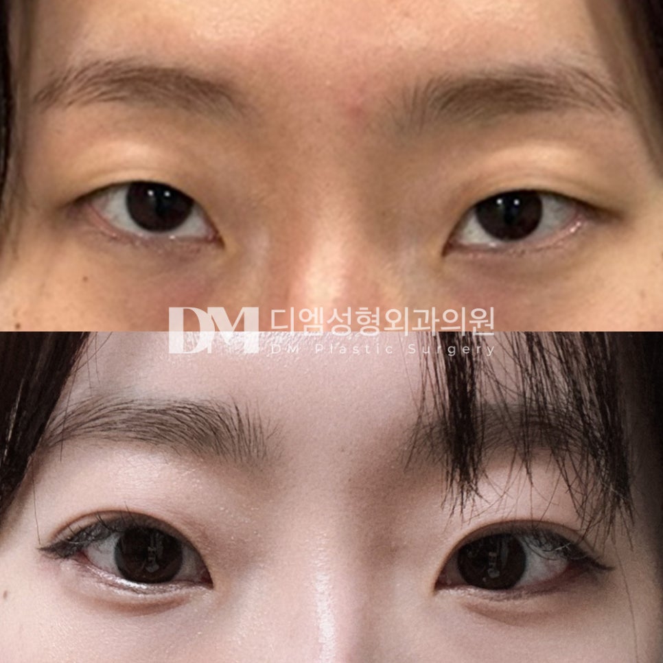 눈성형 후기." 뒷밑트임으로 보다 순한 인상이 되었습니다." 관련 이미지 2