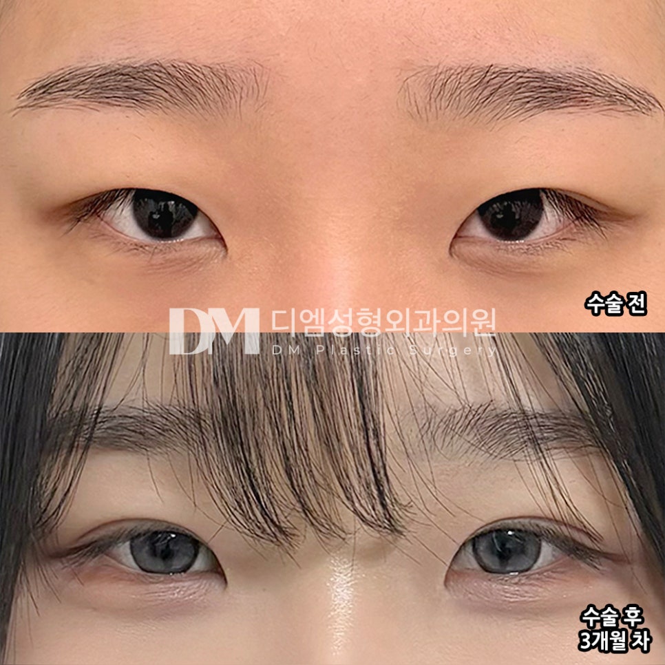 DM Eyelid Correction / Eye Surgery Review, “The swelling seems to have almost completely gone down, and the line has become much more natural!” image 2