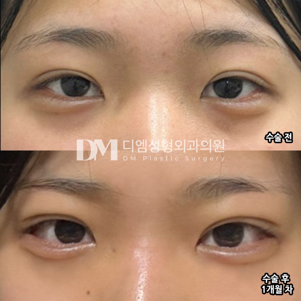 Bbang Eye Corner Surgery Review. “I was really glad that I could get both outer corner and lower corner surgery at such a good price!!” image 2