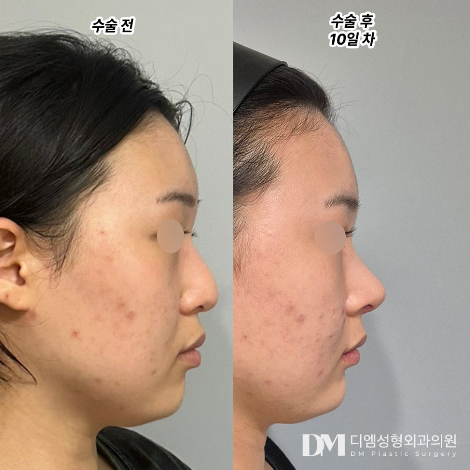 코성형 후기."자연스러우면서 확실한 효과가 있어 너무 좋았어요!" 관련 이미지 2