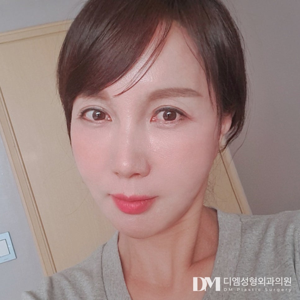 안면거상, 젊은 시절의 나를 되찾고 싶다면 관련 이미지 1