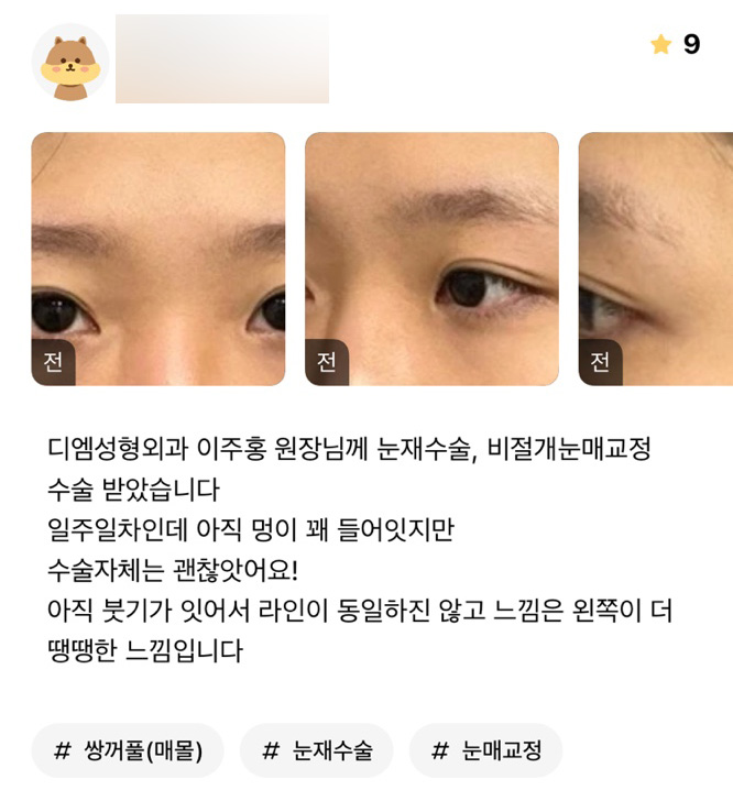 Eye Revision Surgery Review: “There’s Still Some Swelling, but the Surgery Itself Was Fine!” image 1